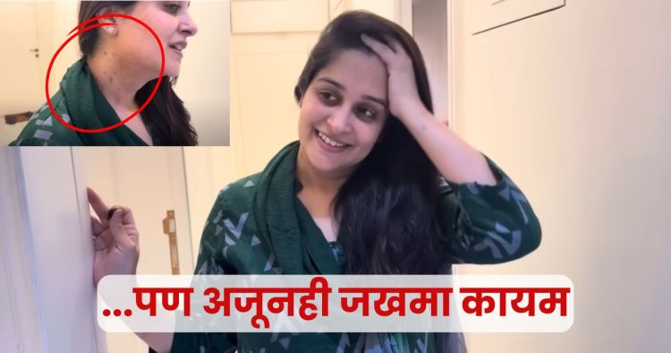 Deepika Kakkar Scars